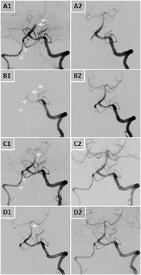 Case Report: Four Early Recurrent Basilar Artery Occlusions Successfully Treated With Mechanical Thrombectomy and Subsequent Vertebral Artery Coil Occlusion